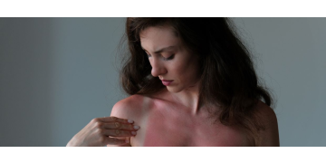 Arsuri solare: cum sa ameliorezi durerea si disconfortul