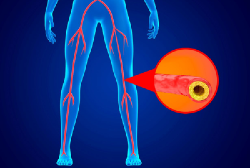 Boala arteriala periferica