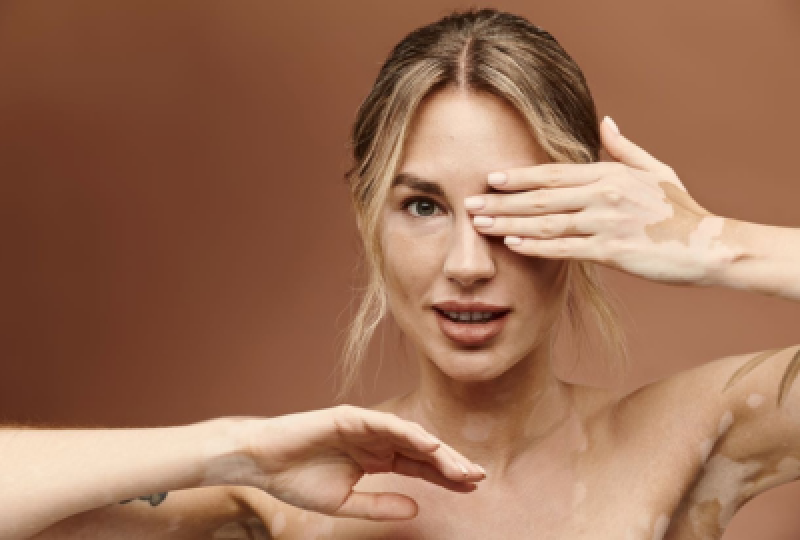 Este vitiligo o boala contagioasa?