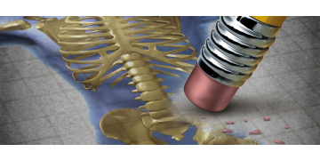 Coxartroza: simptome, cauze, tratament si preventie