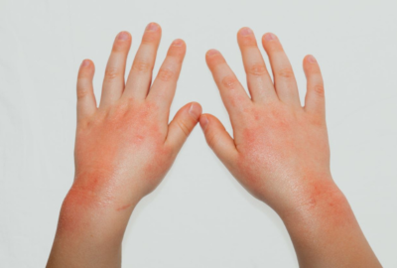 Afectiuni dermatologice in sezonul rece