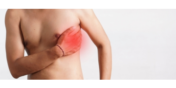 Fractura costala: cauze, simptome, diagnostic si recuperare