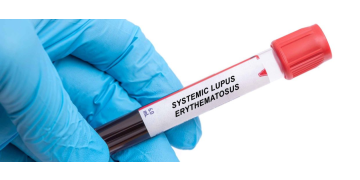 Lupus Eritematos Sistemic (LES): cauze, simptome, tratament