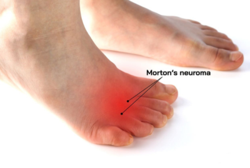 Neurom morton