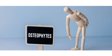 Osteofite - cauze, tipuri in functie de localizare si tratament