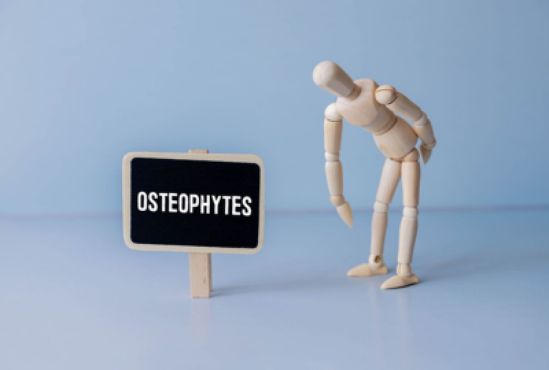 Osteofite - cauze, tipuri in functie de localizare si tratament
