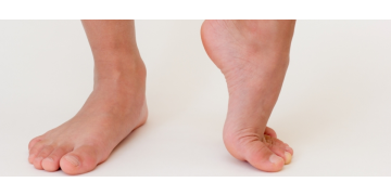 Picior scobit la copii: cauze, factori de risc si tratamente