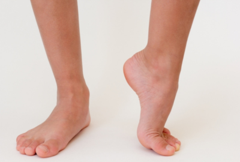 Picior scobit la copii: cauze, factori de risc si tratamente