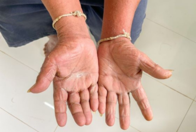 Sclerodermia