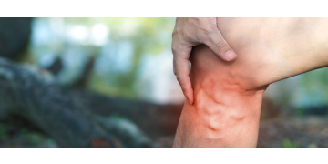 Varice: ghid complet simptome, cauze, tratament si preventie