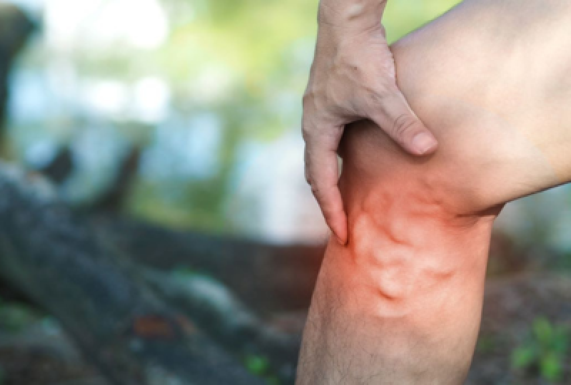 Varice: ghid complet simptome, cauze, tratament si preventie