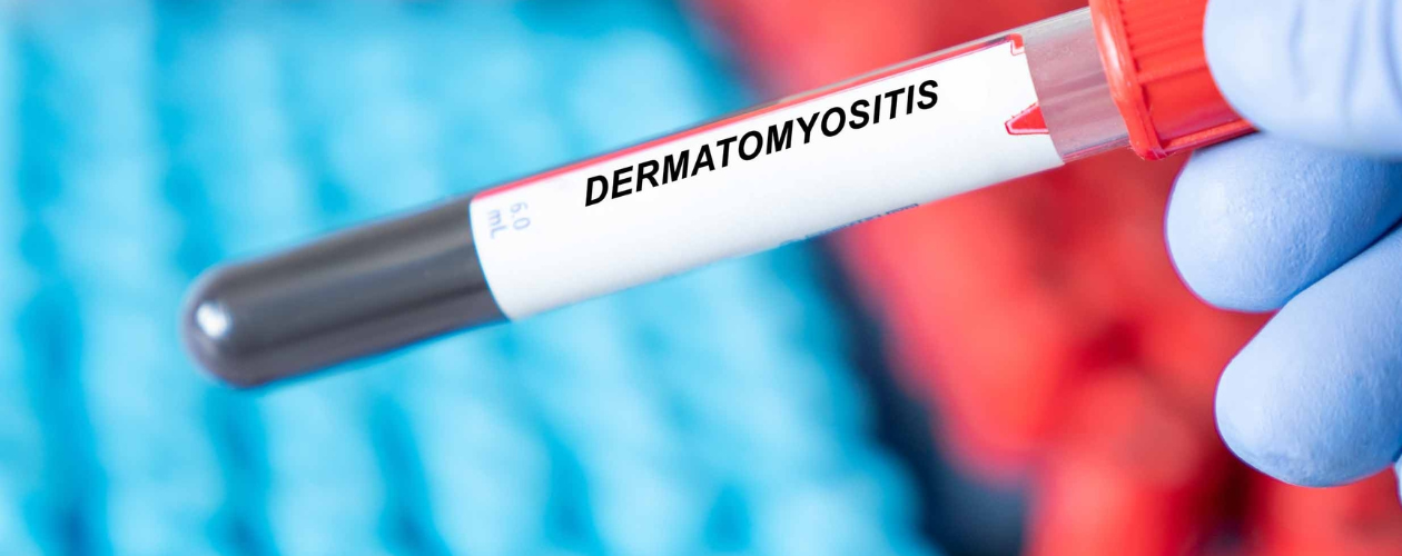 Dermatomiozita: cauze, simptome si tratament