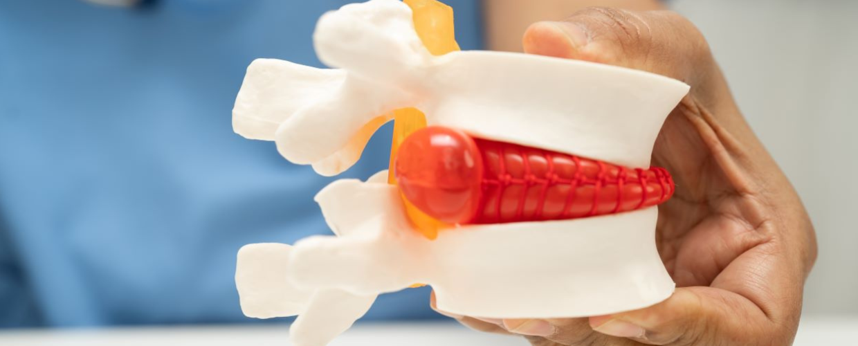 Hernie de disc: simptome, cauze, diagnostic si tratament