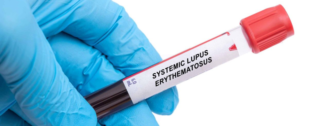 Lupus Eritematos Sistemic (LES): cauze, simptome, tratament