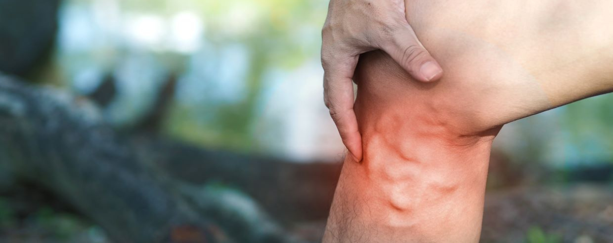 Varice: ghid complet simptome, cauze, tratament si preventie